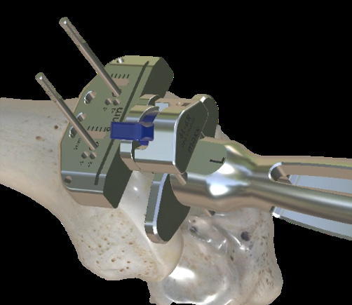 Original Maxx Freedom R10, page 8 · distal femoral IM guide